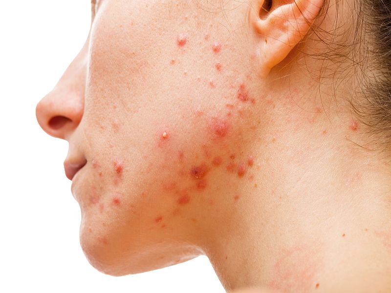 Qué es el acné ??